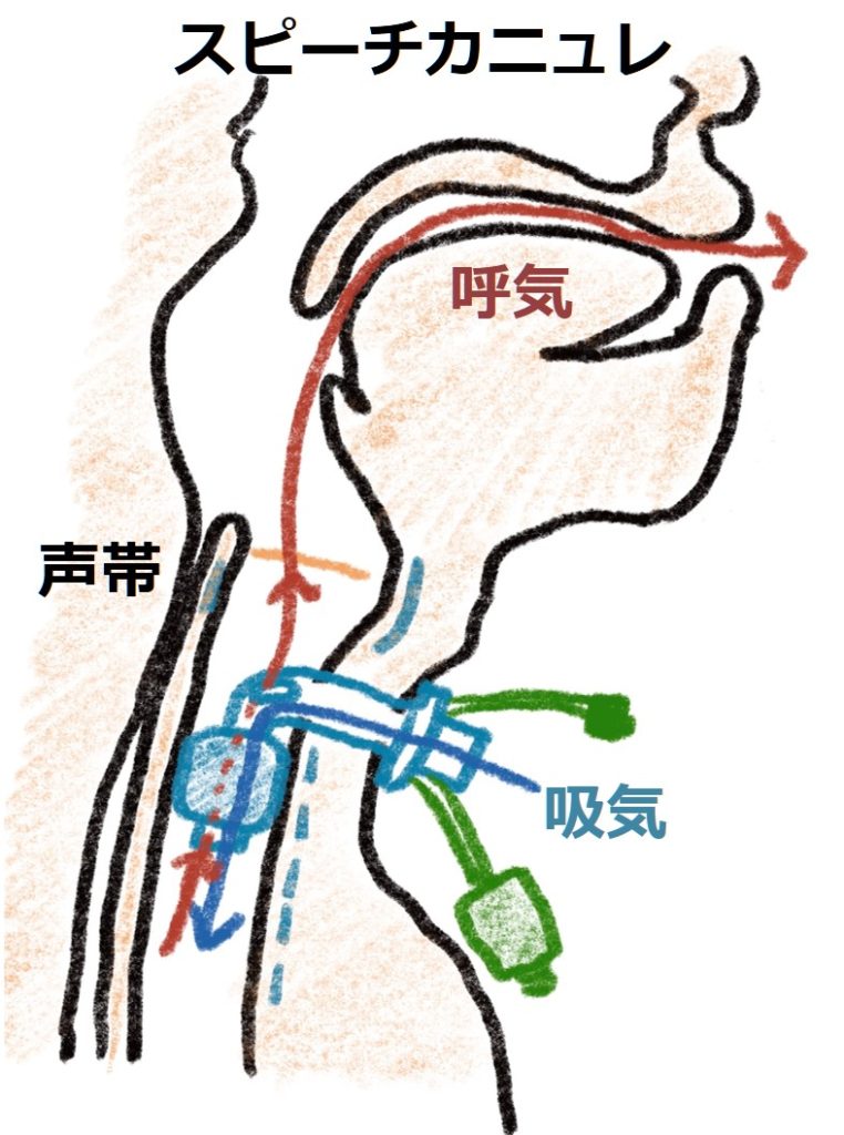切開 気管 突然突きつけられる高齢者の気管挿管（気管切開）の決定・・後悔しないための7つのポイント