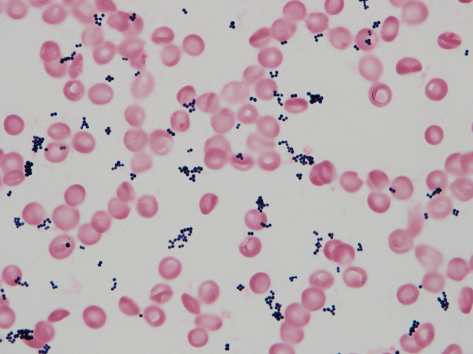 黄色ブドウ球菌菌血症 SAB: Staphylococcus aureus bacteremia