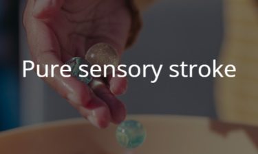 感覚障害のみを呈する脳梗塞　Pure sensory stroke
