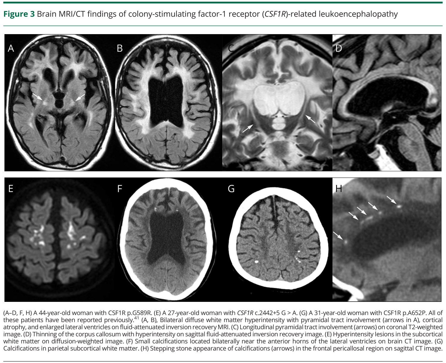 HDLS/ALSP: hereditary diffuse leukoencephalopathy with spheroid/Adult onset leukoencephalopathy with neuroaxonal spheroids and pigmented glia