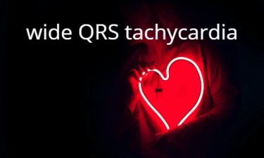 wide QRS tachycardia