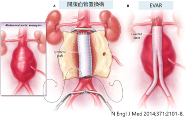 腹部大動脈瘤 AAA: abdominal aortic aneurysms