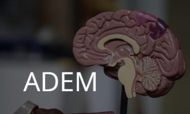 ADEM: acute disseminated encephalomyelitis