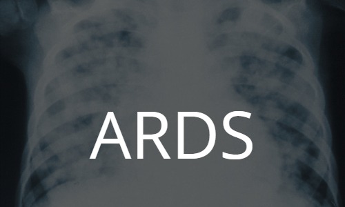 ARDS: acute respiratory distress syndrome